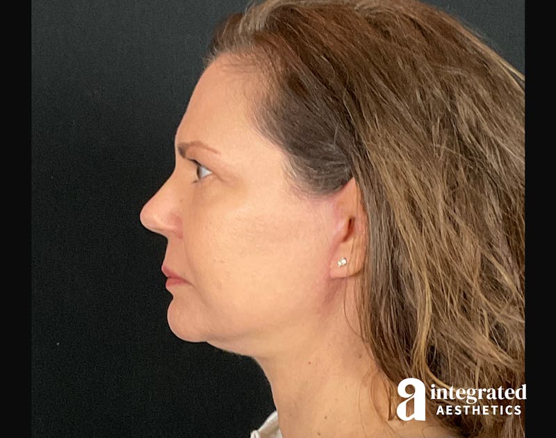 Facelift & Neck Lift Before & After Gallery - Patient 133212893 - Image 8