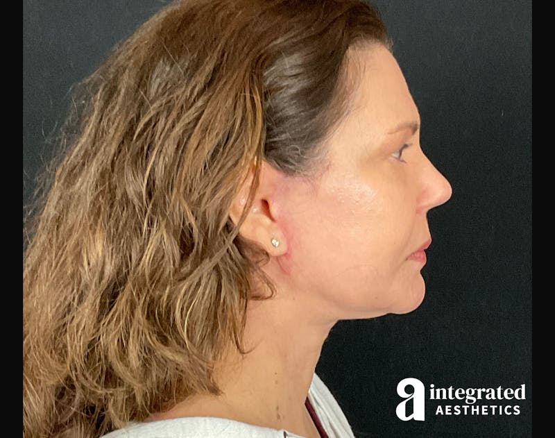 Facelift & Neck Lift Before & After Gallery - Patient 133212893 - Image 10