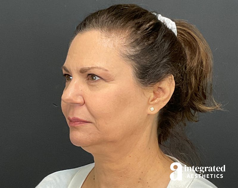 Facelift & Neck Lift Before & After Gallery - Patient 133212893 - Image 5
