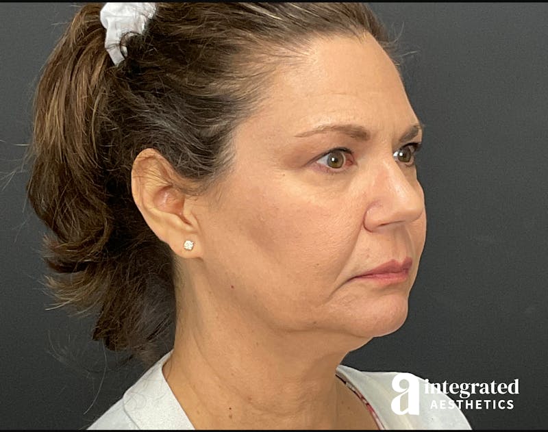Facelift & Neck Lift Before & After Gallery - Patient 133212893 - Image 1