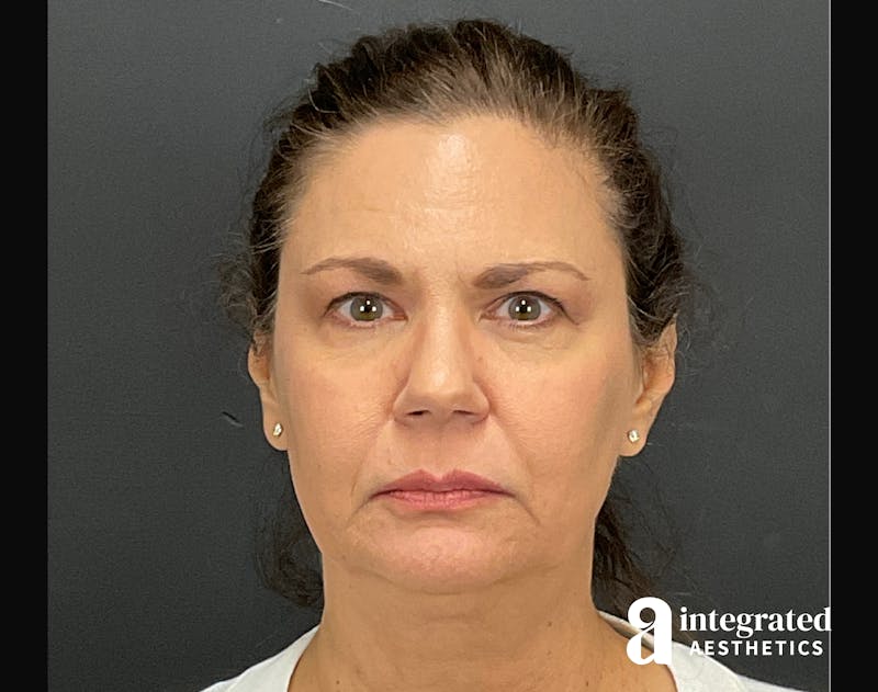 Facelift & Neck Lift Before & After Gallery - Patient 133212893 - Image 3