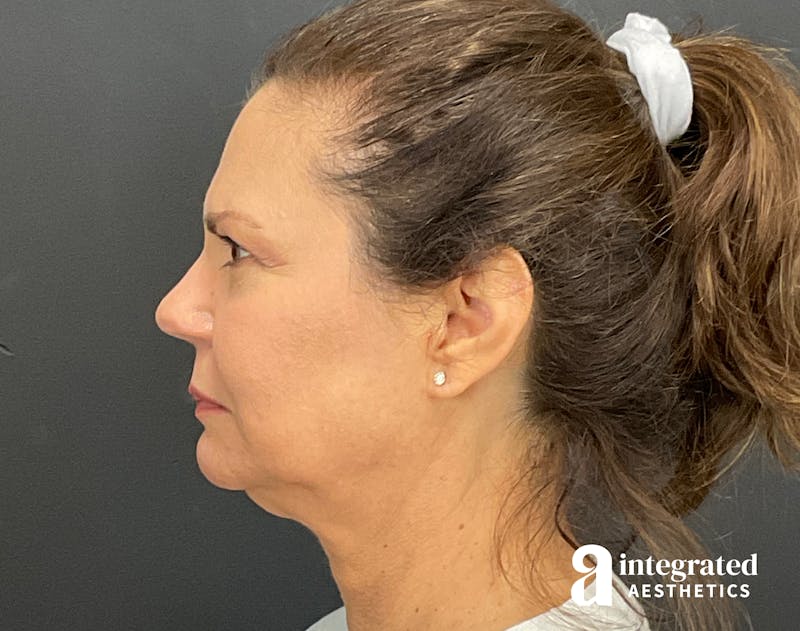 Facelift & Neck Lift Before & After Gallery - Patient 133212893 - Image 7