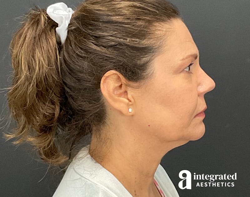Facelift & Neck Lift Before & After Gallery - Patient 133212893 - Image 9