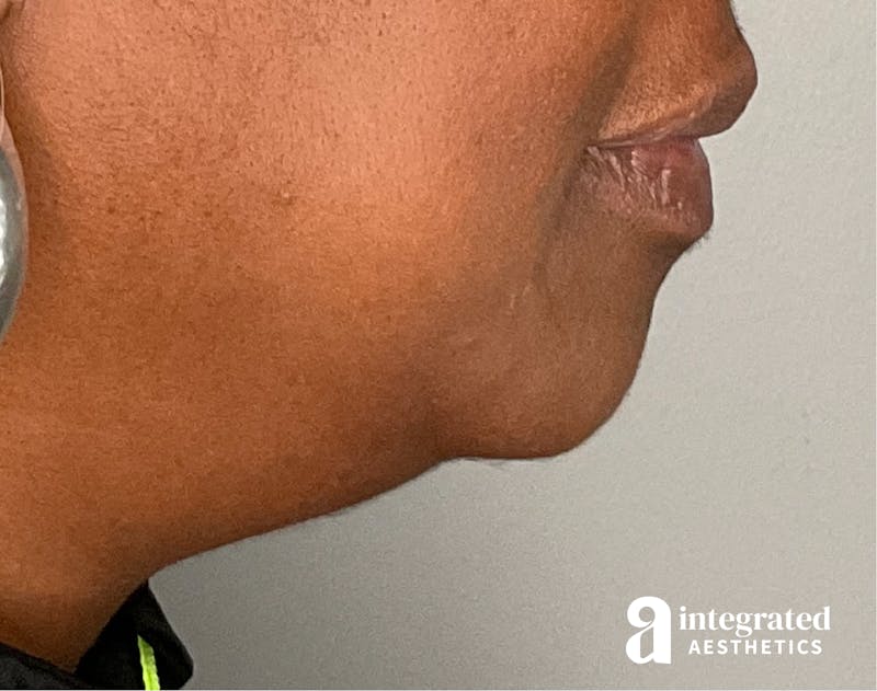 Kybella Before & After Gallery - Patient 133212945 - Image 1