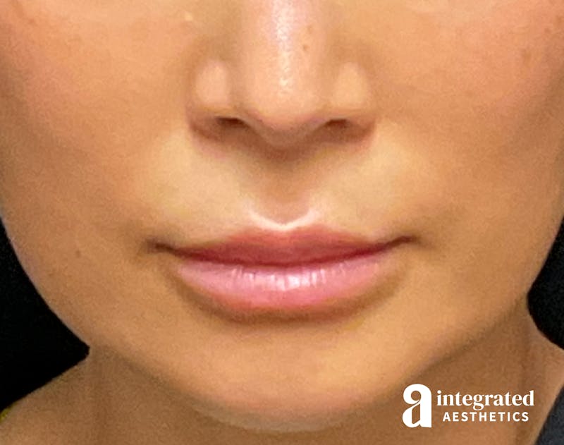 Lip Lift Before & After Gallery - Patient 133212957 - Image 1