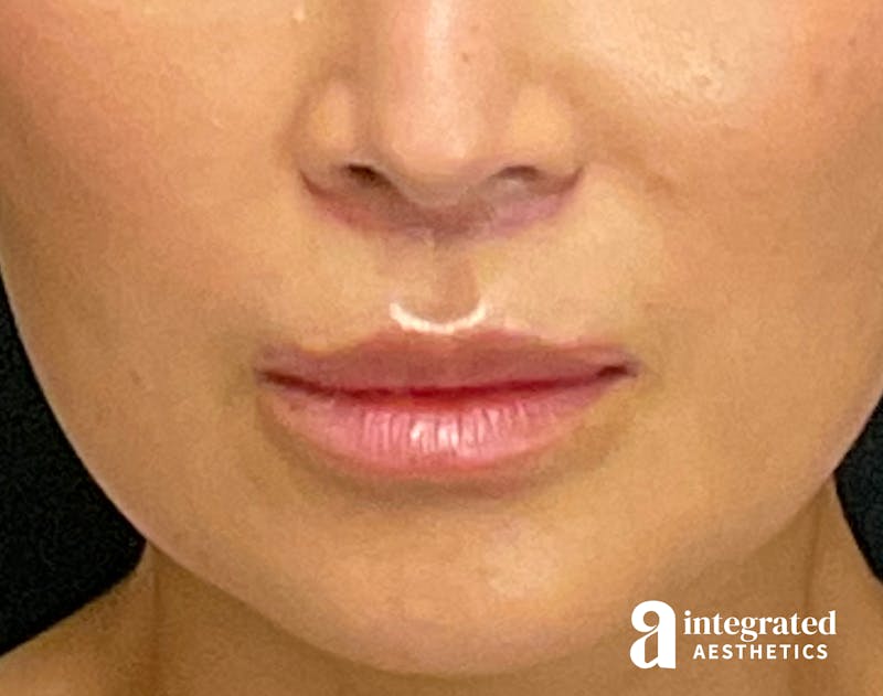 Lip Lift Before & After Gallery - Patient 133212957 - Image 2