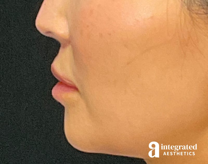 Lip Lift Before & After Gallery - Patient 133212957 - Image 6