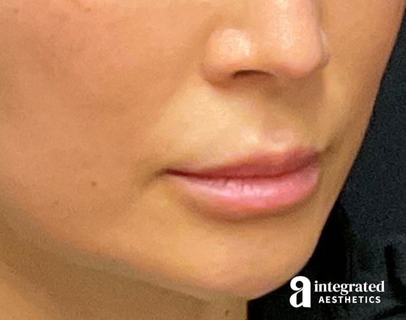 Lip Lift Before & After Gallery - Patient 133212957 - Image 7