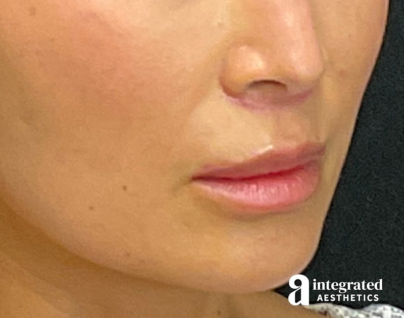 Lip Lift Before & After Gallery - Patient 133212957 - Image 8