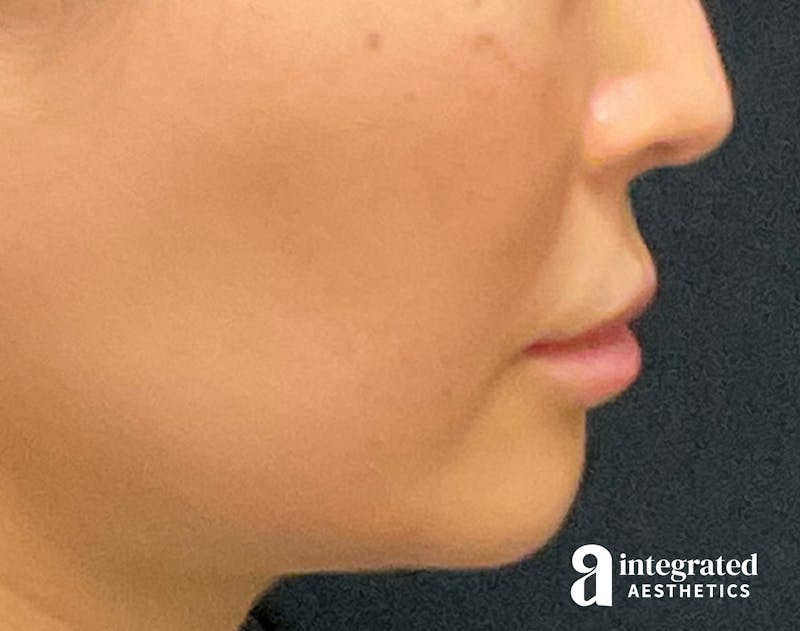 Lip Lift Before & After Gallery - Patient 133212957 - Image 9