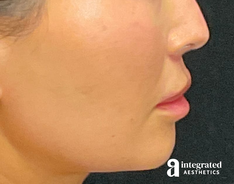 Lip Lift Before & After Gallery - Patient 133212957 - Image 10