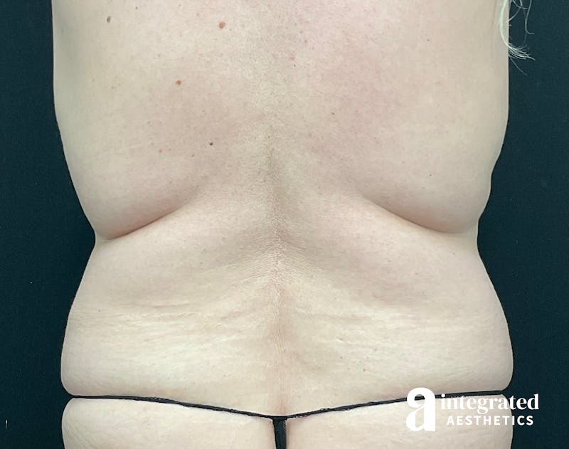 Liposuction Before & After Gallery - Patient 133212959 - Image 1