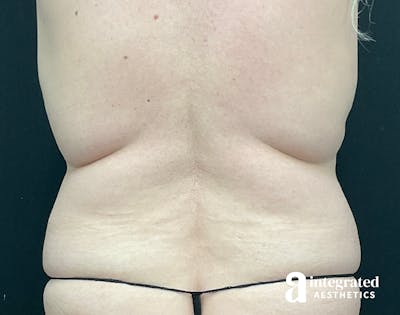 Liposuction Before & After Gallery - Patient 133212959 - Image 1
