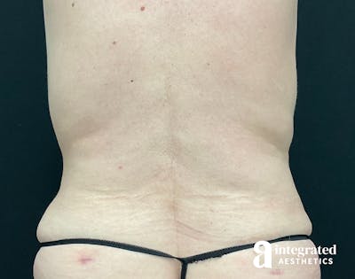 Liposuction Before & After Gallery - Patient 133212959 - Image 2