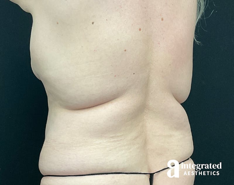 Liposuction Before & After Gallery - Patient 133212959 - Image 3
