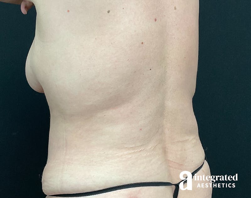 Liposuction Before & After Gallery - Patient 133212959 - Image 4