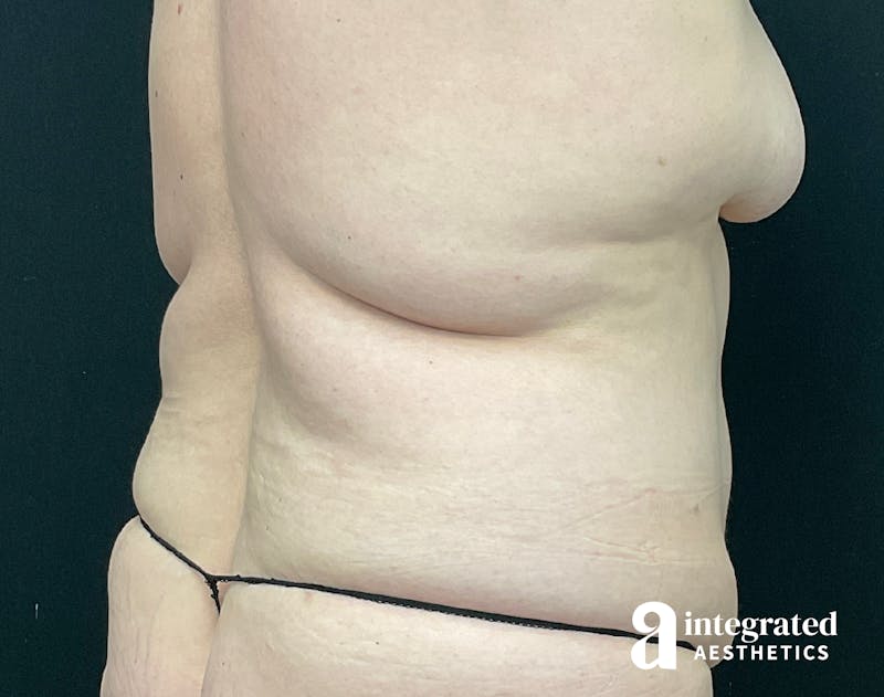 Liposuction Before & After Gallery - Patient 133212959 - Image 5