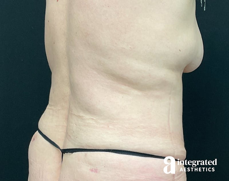 Liposuction Before & After Gallery - Patient 133212959 - Image 6