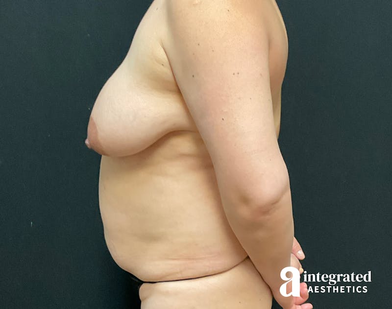 Mommy Makeover Before & After Gallery - Patient 133213052 - Image 7