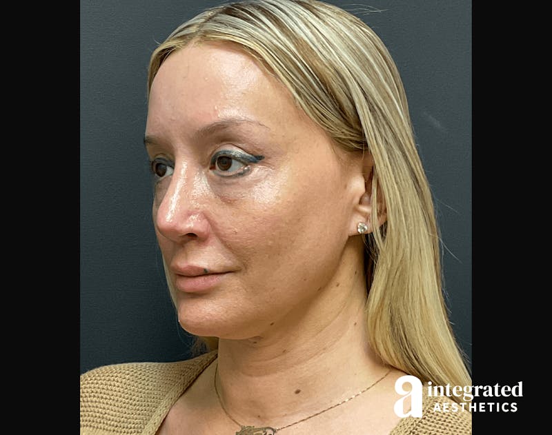 Morpheus8 Before & After Gallery - Patient 133213113 - Image 4