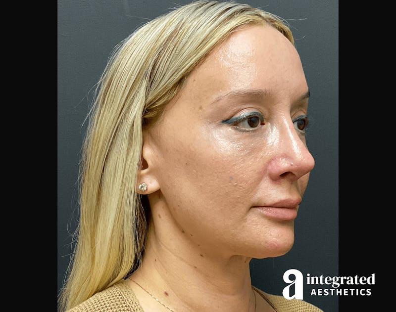 Morpheus8 Before & After Gallery - Patient 133213113 - Image 6