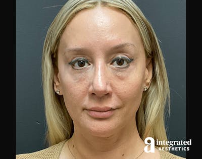 Morpheus8 Before & After Gallery - Patient 133213113 - Image 2