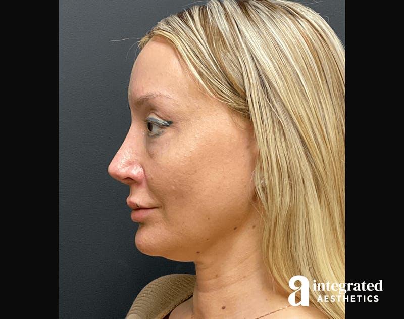 Morpheus8 Before & After Gallery - Patient 133213113 - Image 8