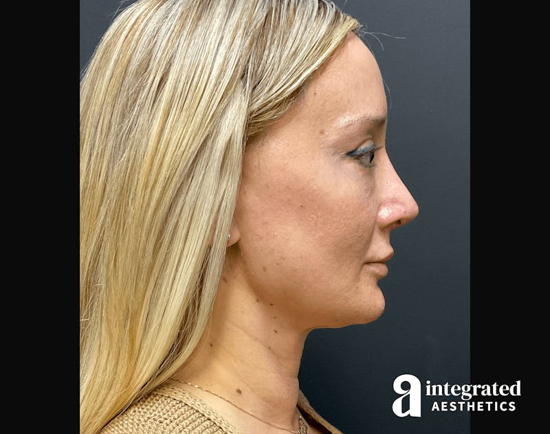 Morpheus8 Before & After Gallery - Patient 133213113 - Image 10