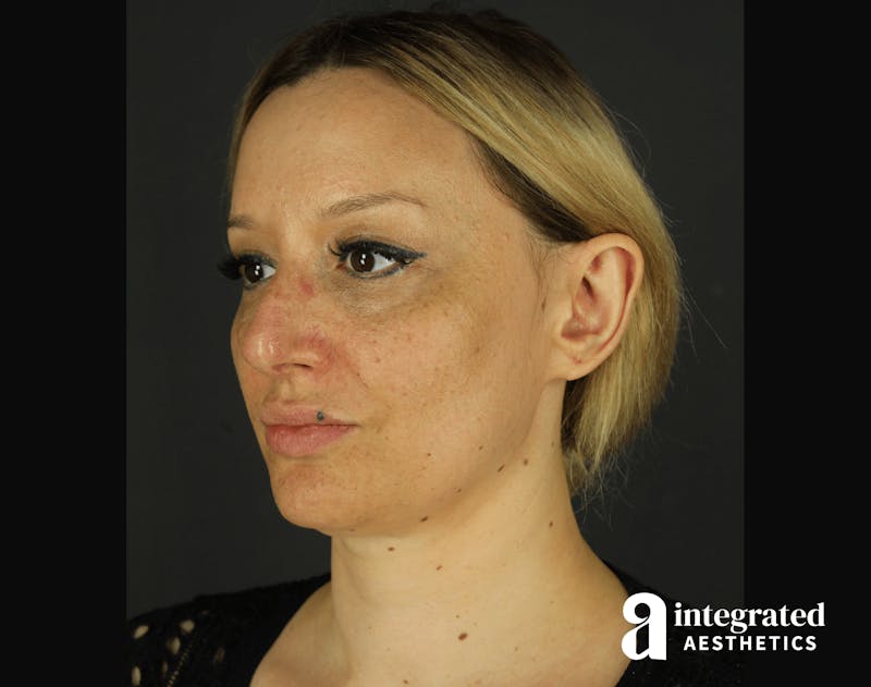 Morpheus8 Before & After Gallery - Patient 133213113 - Image 3