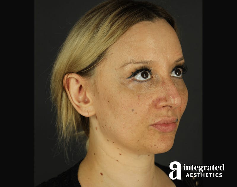 Morpheus8 Before & After Gallery - Patient 133213113 - Image 5