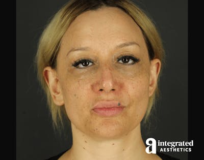 Morpheus8 Before & After Gallery - Patient 133213113 - Image 1