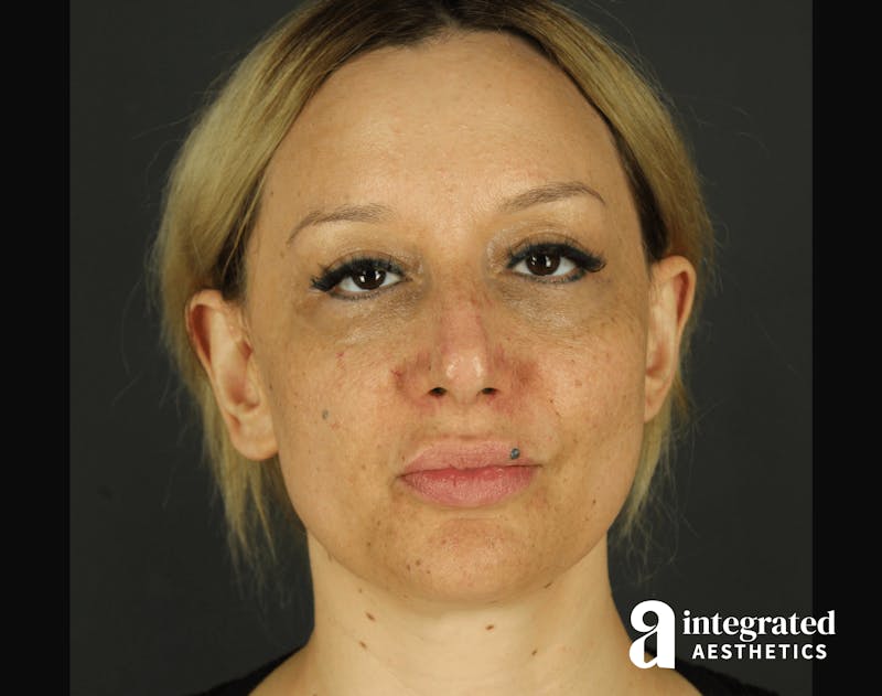 Morpheus8 Before & After Gallery - Patient 133213113 - Image 1