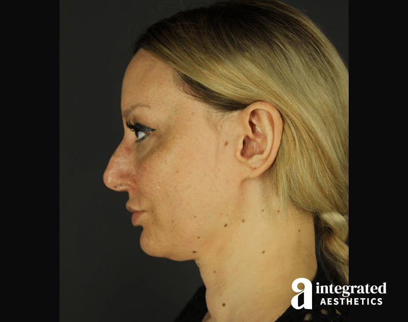 Morpheus8 Before & After Gallery - Patient 133213113 - Image 7