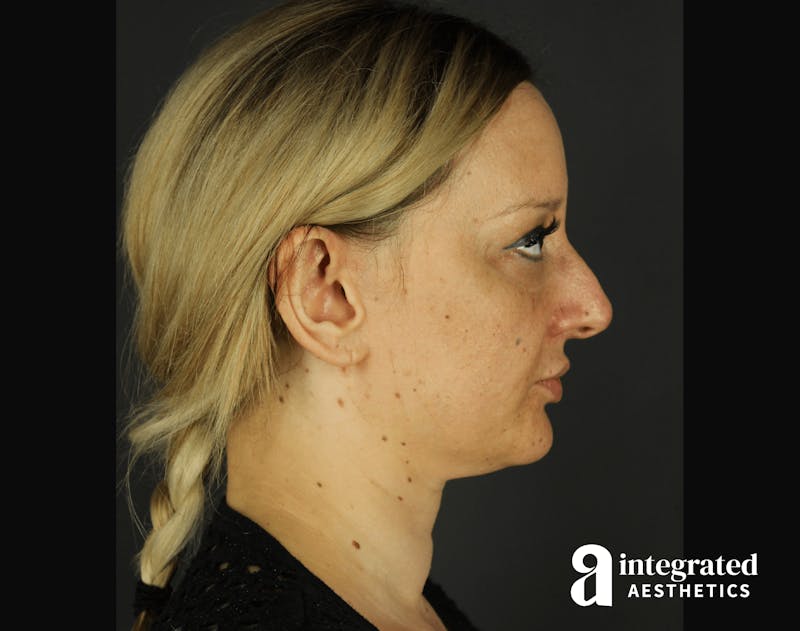 Morpheus8 Before & After Gallery - Patient 133213113 - Image 9
