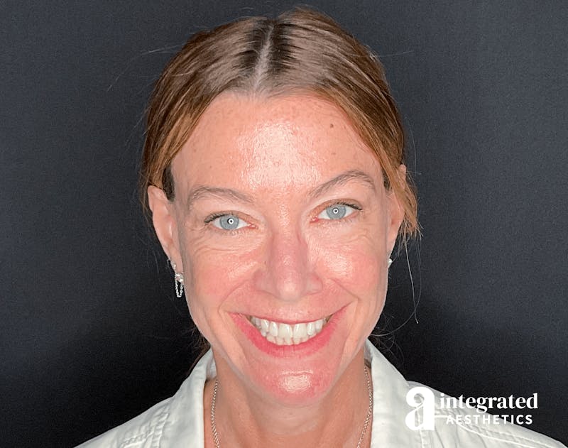 Sculptra Before & After Gallery - Patient 133213289 - Image 3