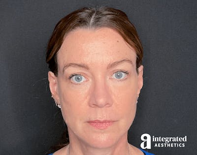 Radiesse Before & After Gallery - Patient 133213185 - Image 2