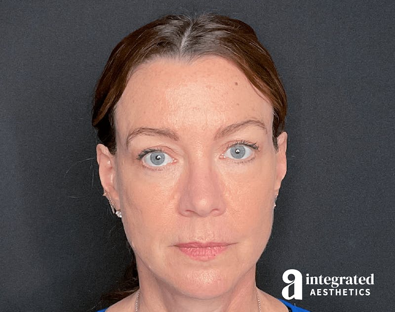 Sculptra Before & After Gallery - Patient 133213289 - Image 2