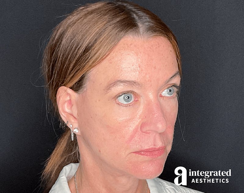 Sculptra Before & After Gallery - Patient 133213289 - Image 7