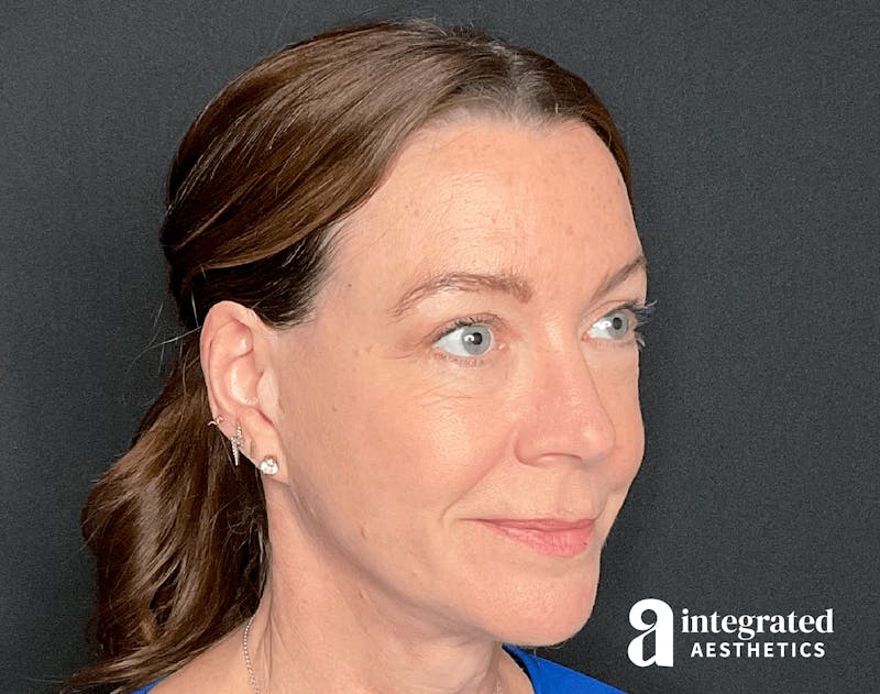Sculptra Before & After Gallery - Patient 133213289 - Image 6