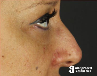 Rhinoplasty Before & After Gallery - Patient 133213227 - Image 1