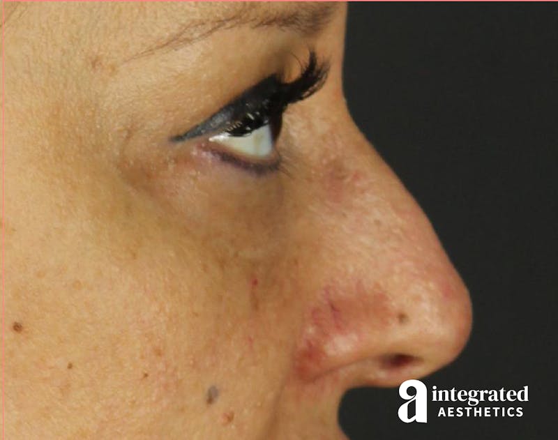 Rhinoplasty Before & After Gallery - Patient 133213227 - Image 1