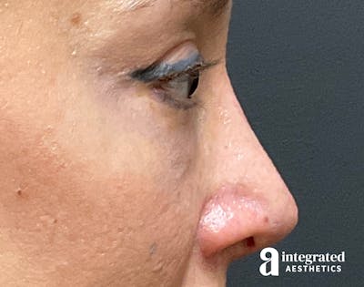 Rhinoplasty Before & After Gallery - Patient 133213227 - Image 2