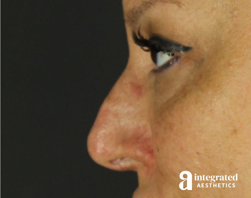 Rhinoplasty Before & After Gallery - Patient 133213227 - Image 9