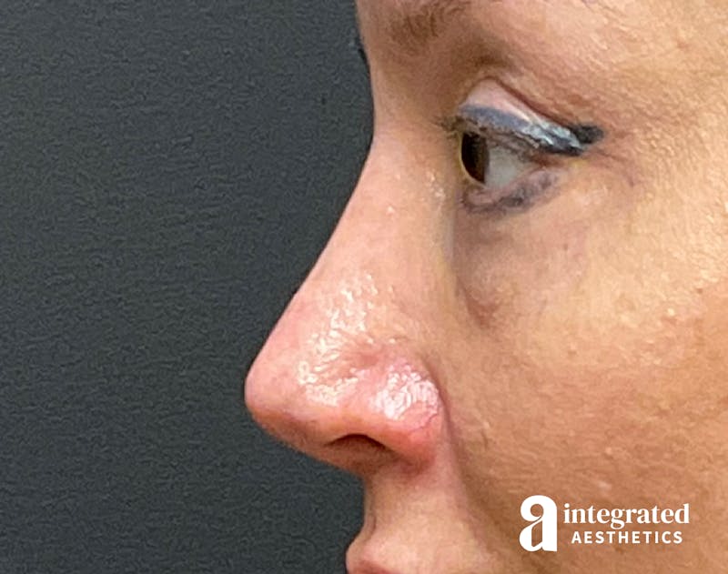Rhinoplasty Before & After Gallery - Patient 133213227 - Image 10