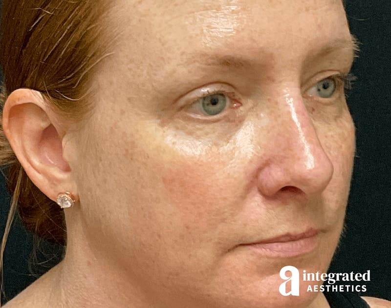 Rhinoplasty Before & After Gallery - Patient 133213248 - Image 6