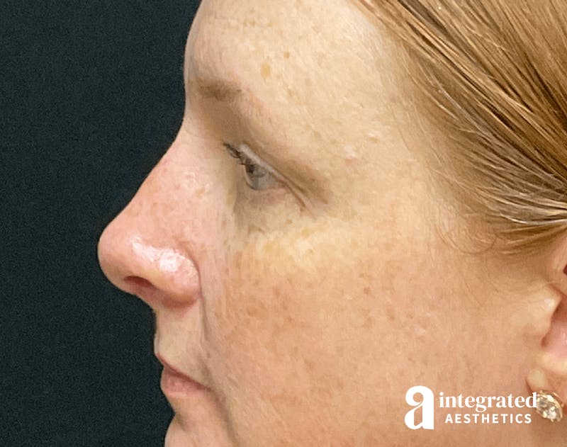 Rhinoplasty Before & After Gallery - Patient 133213248 - Image 10