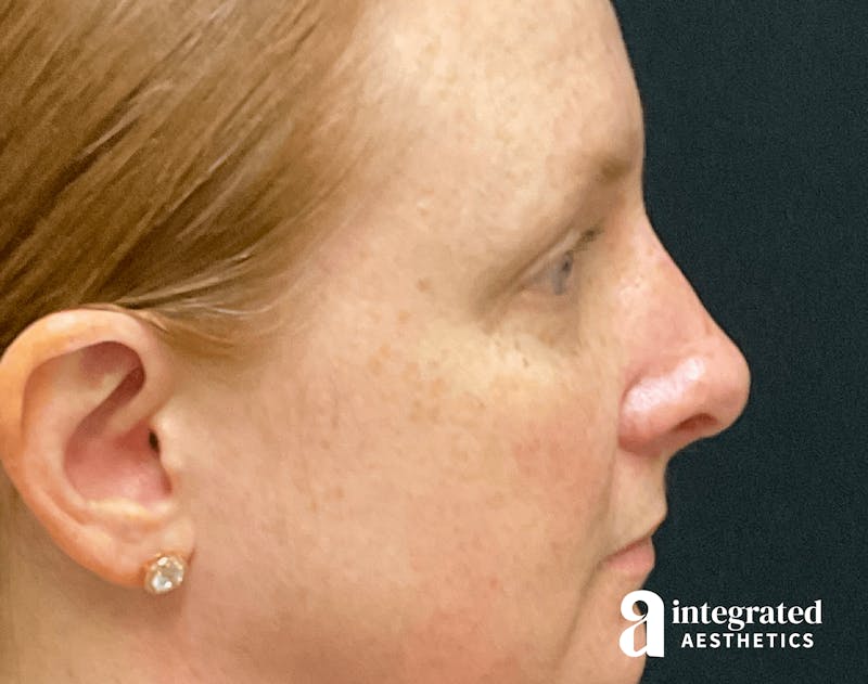 Rhinoplasty Before & After Gallery - Patient 133213248 - Image 2