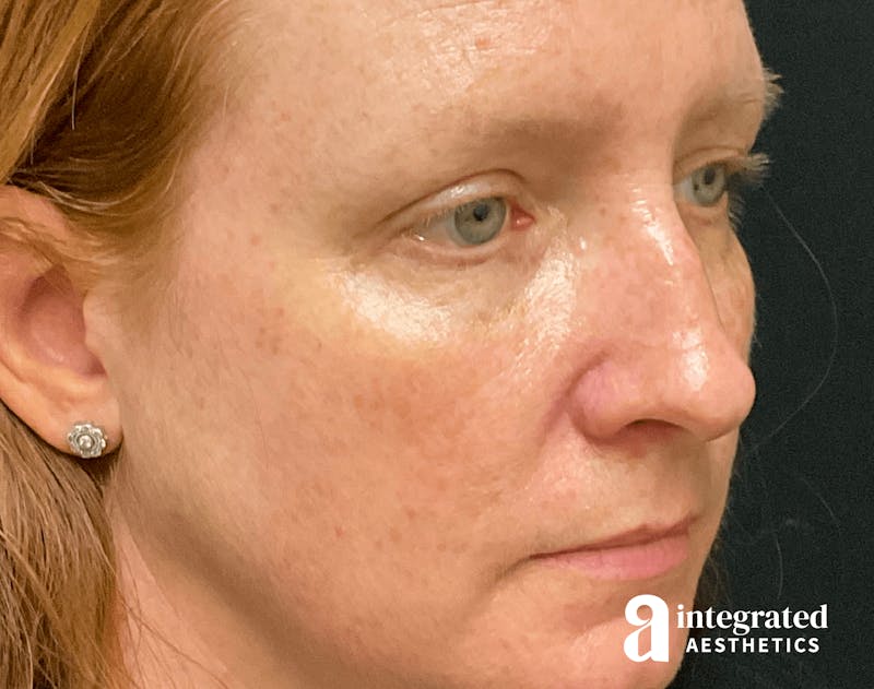 Rhinoplasty Before & After Gallery - Patient 133213248 - Image 5