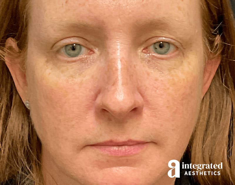 Rhinoplasty Before & After Gallery - Patient 133213248 - Image 7