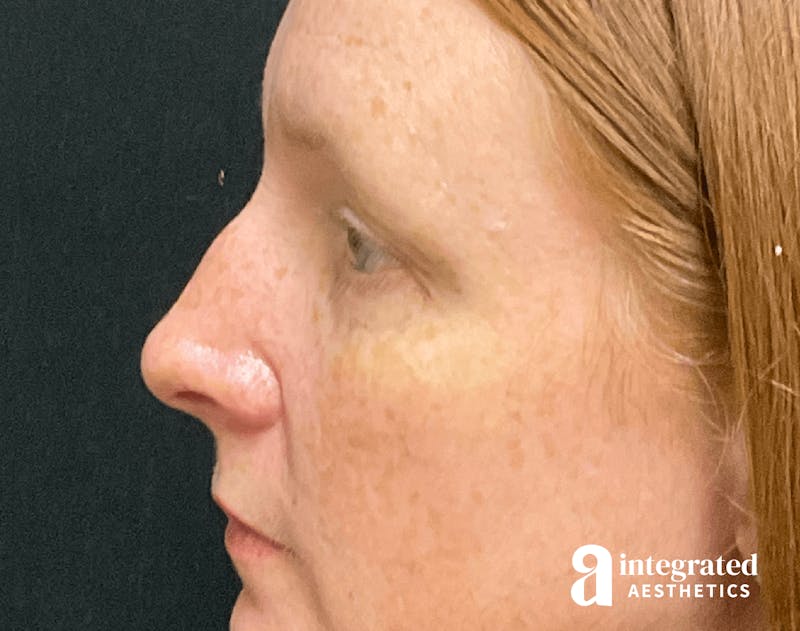 Rhinoplasty Before & After Gallery - Patient 133213248 - Image 9